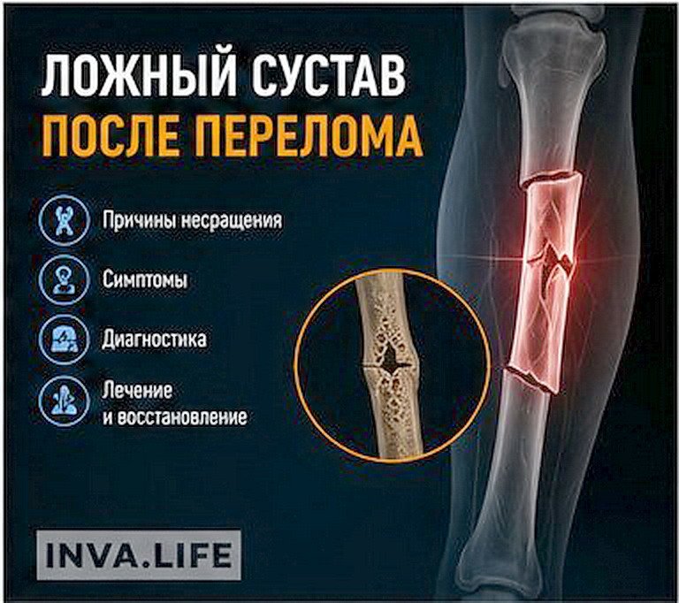 08_Ложный_сустав.jpg